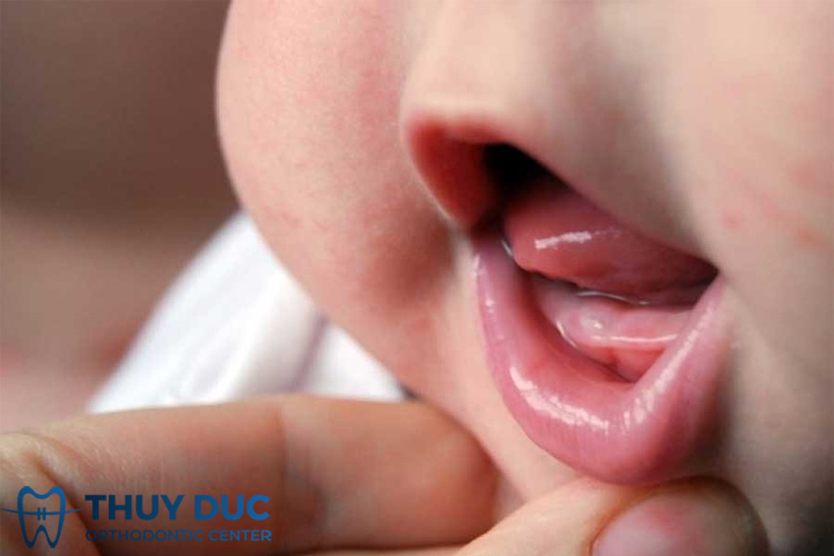 1. Như thế nào được gọi là mọc răng chậm? 1 1. Như thế nào được gọi là mọc răng chậm? 1