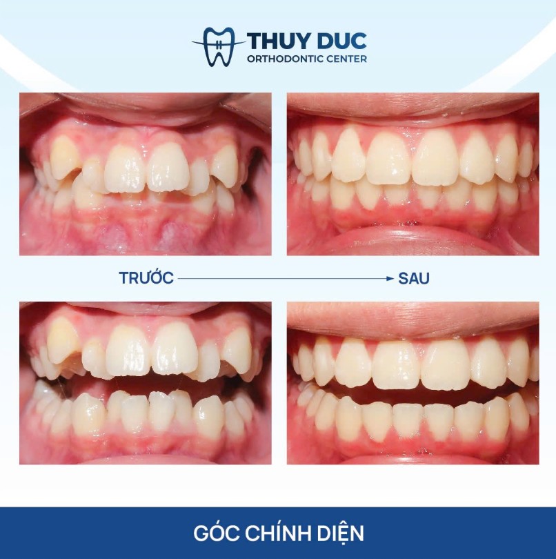 2. Khác biệt giữa chỉnh nha thông thường và chỉnh nha tiền phục hình 1 2. Khác biệt giữa chỉnh nha thông thường và chỉnh nha tiền phục hình 1