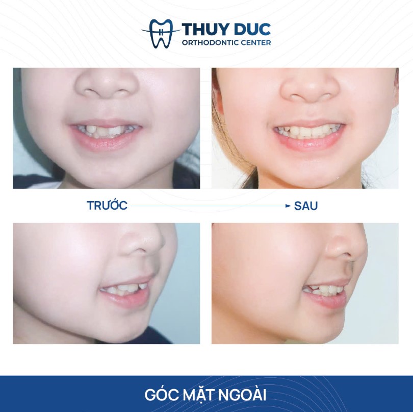 1. Niềng răng ảnh hưởng thế nào đến cấu trúc khuôn mặt? 2