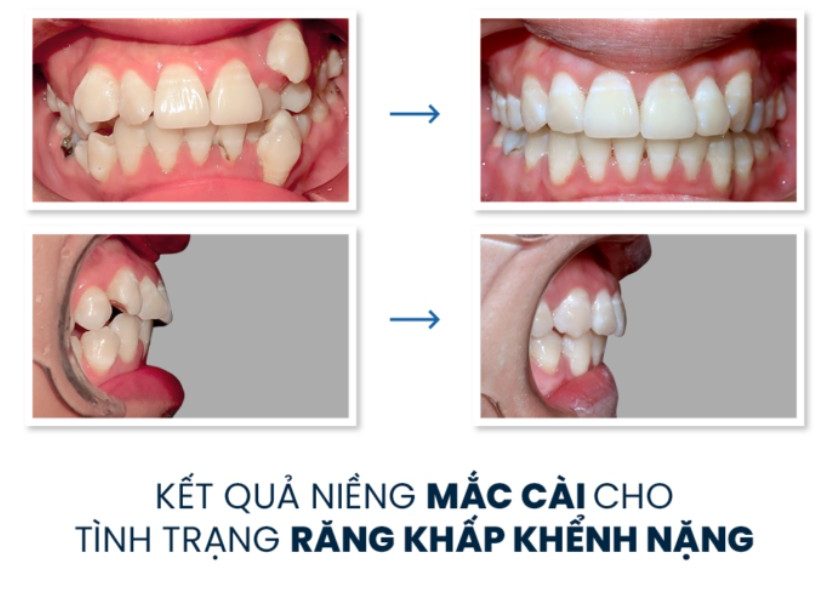 Hiểu lầm 1: Niềng răng gây lệch mặt do ảnh hưởng thần kinh 1