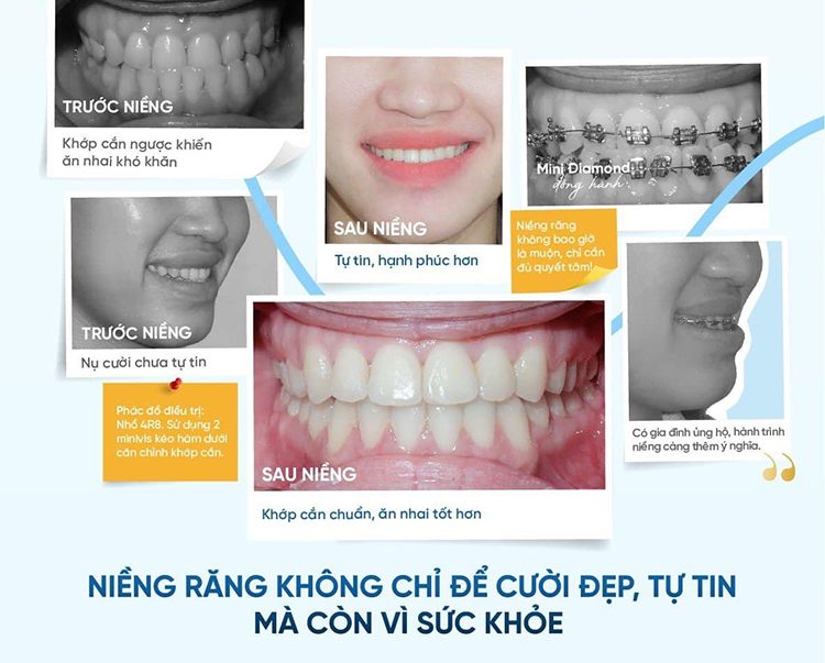 Niềm tin: niềng răng sẽ thay đổi tướng số 1