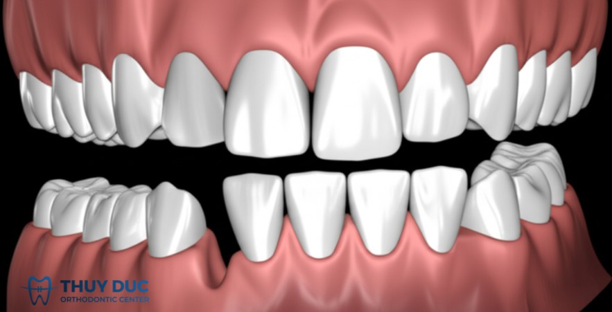 4. Không đủ khoảng để làm phục hình 1 4. Không đủ khoảng để làm phục hình 1