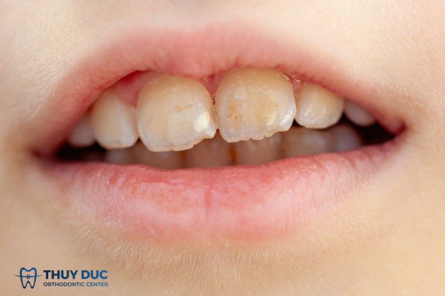 6. Vệ sinh răng miệng không đúng cách 1 6. Vệ sinh răng miệng không đúng cách 1