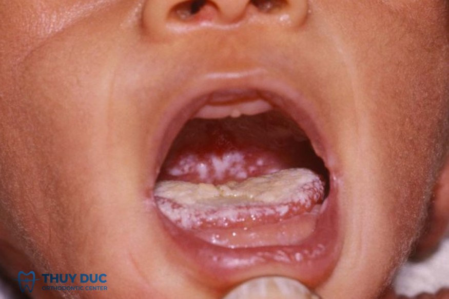 1.3. Tưa lưỡi (nấm miệng) 1 1.3. Tưa lưỡi (nấm miệng) 1