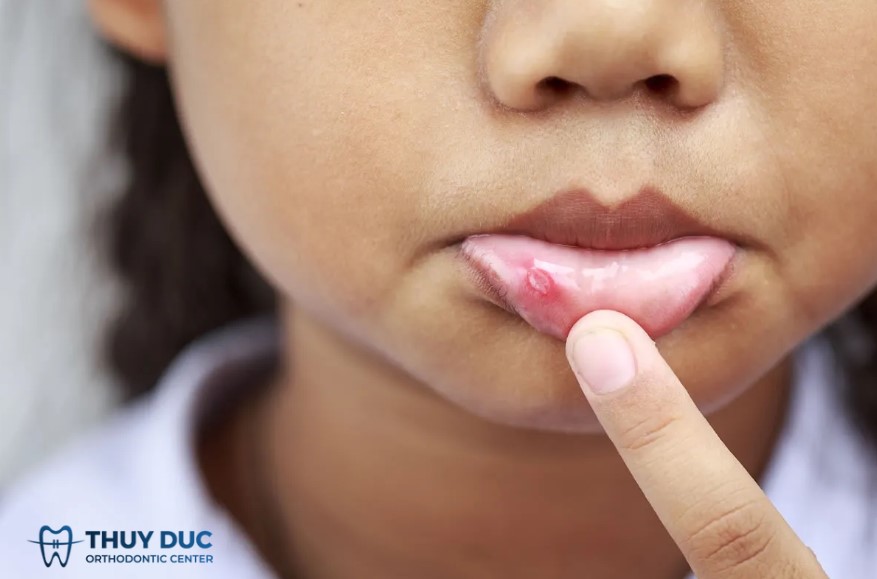 1.4 Loét miệng không nhiễm trùng (nhiệt miệng) 1 1.4 Loét miệng không nhiễm trùng (nhiệt miệng) 1