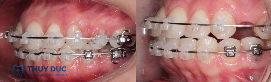 2. Nhổ răng khi niềng răng: Có ảnh hưởng đến thần kinh không? 1 2. Nhổ răng khi niềng răng: Có ảnh hưởng đến thần kinh không? 1