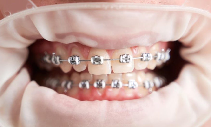 Rủi ro tiềm ẩn với niềng răng kim loại 1