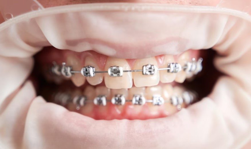 1. Hiểu đúng về niềng răng 1