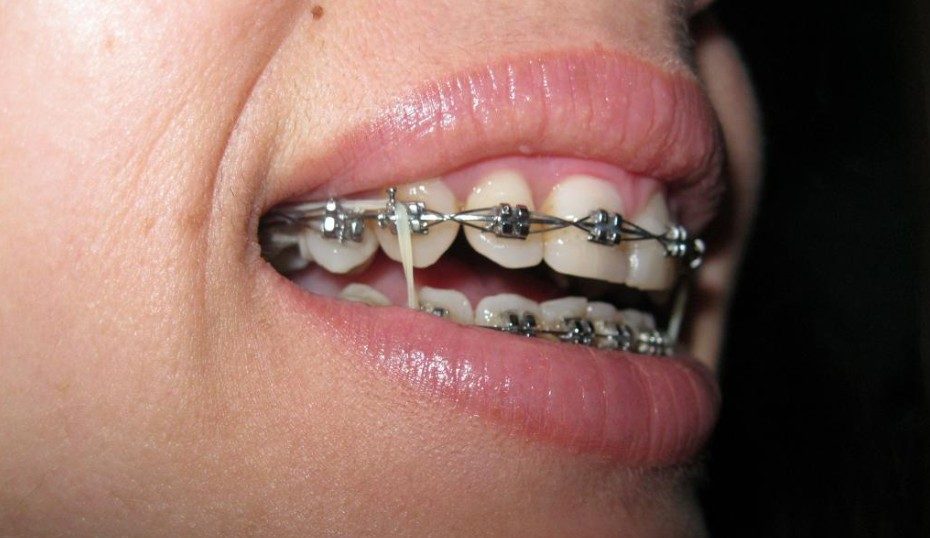 3. Siết chỉnh răng có thể làm tổn thương dây thần kinh không? 1