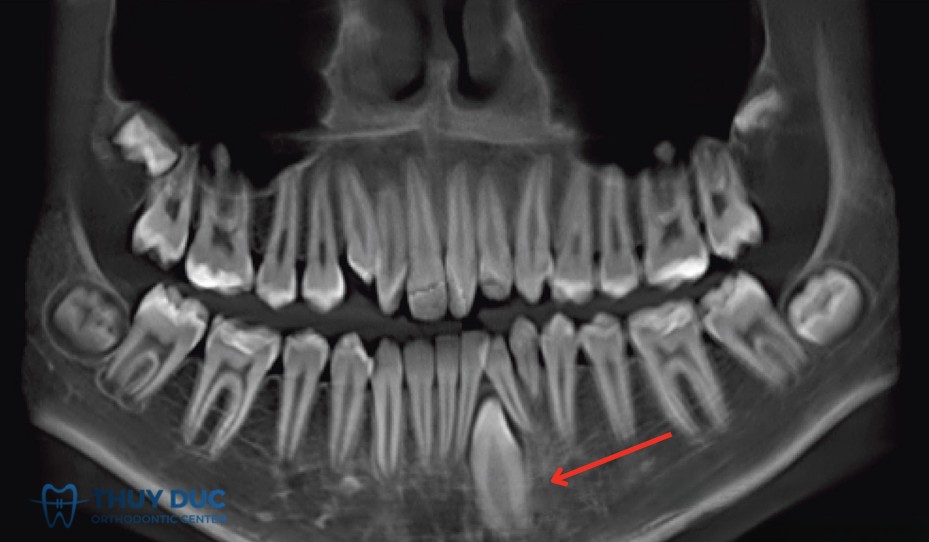 2.3 Răng cửa mọc ngầm 1 2.3 Răng cửa mọc ngầm 1