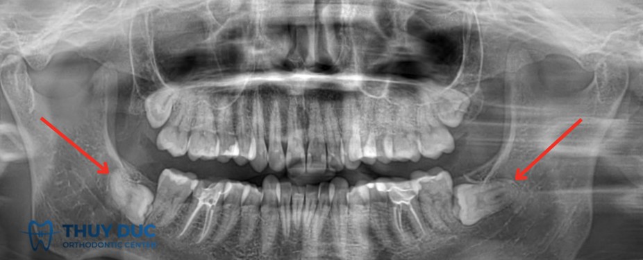 2.1 Răng khôn mọc ngầm 1 2.1 Răng khôn mọc ngầm 1