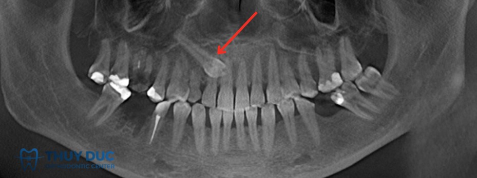2.2 Răng nanh mọc ngầm 1 2.2 Răng nanh mọc ngầm 1