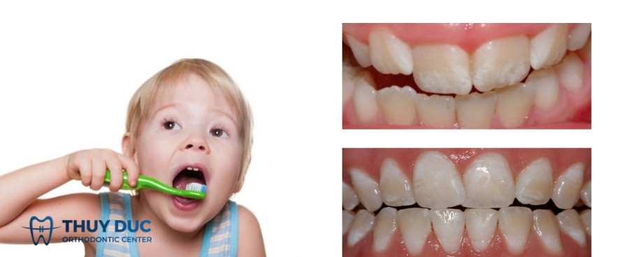 5. Nhiễm Fluoride (Fluorosis) 1 5. Nhiễm Fluoride (Fluorosis) 1