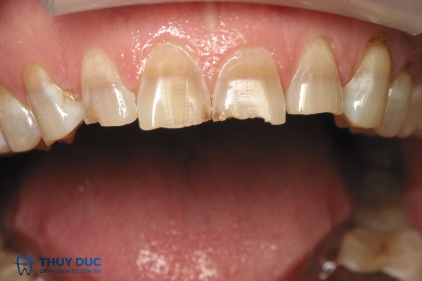 Cơ chế nhiễm màu răng 1 Cơ chế nhiễm màu răng 1