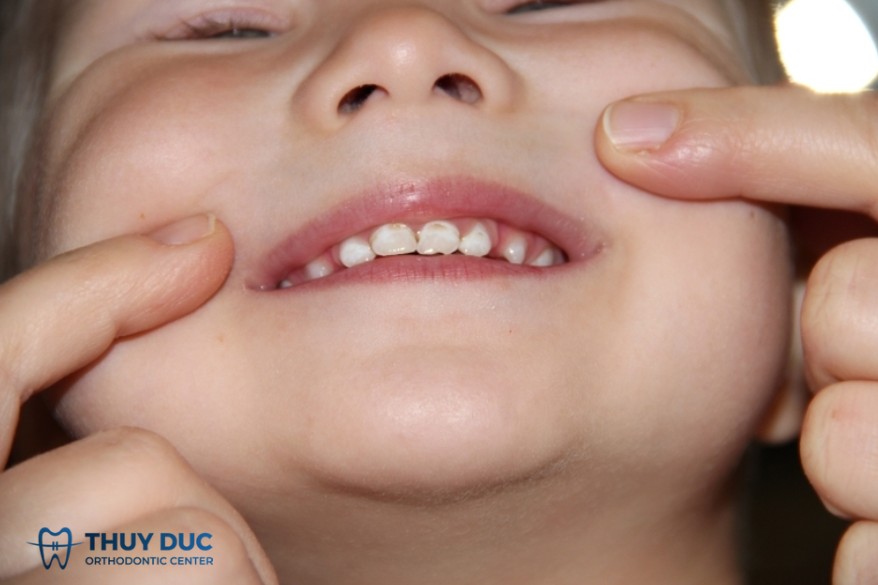 1.1. Thiểu sản men răng (Hypoplasia) 1 1.1. Thiểu sản men răng (Hypoplasia) 1