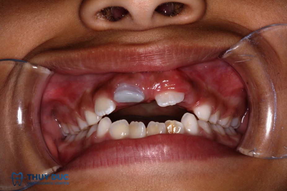 2. Phân loại mức độ vỡ răng của trẻ 1