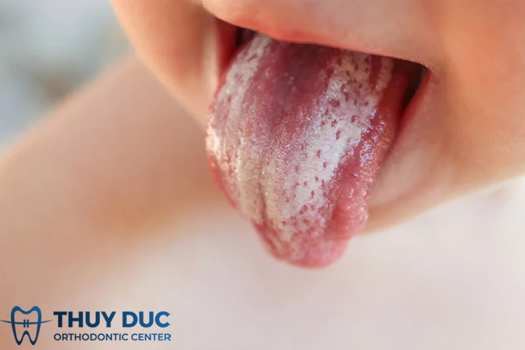 1.2 Viêm niêm mạc miệng do nấm Candida albicans (tưa miệng) 1 1.2 Viêm niêm mạc miệng do nấm Candida albicans (tưa miệng) 1