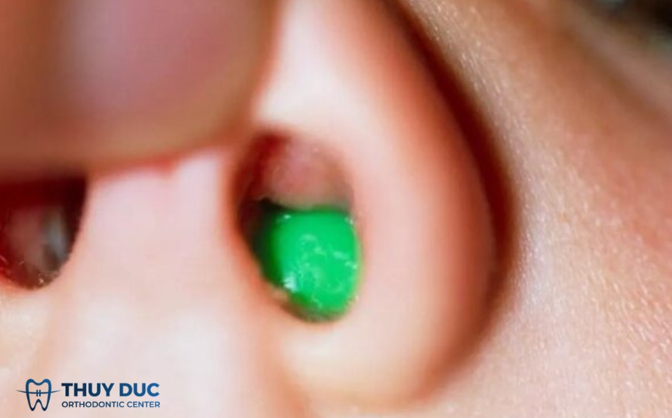 1.8. Dị vật trong mũi (trẻ nhỏ) 1 1.8. Dị vật trong mũi (trẻ nhỏ) 1