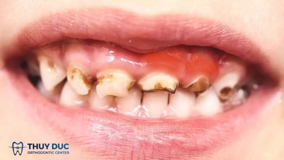 4.2. Diễn biến nặng nếu không được can thiệp sớm 1 4.2. Diễn biến nặng nếu không được can thiệp sớm 1